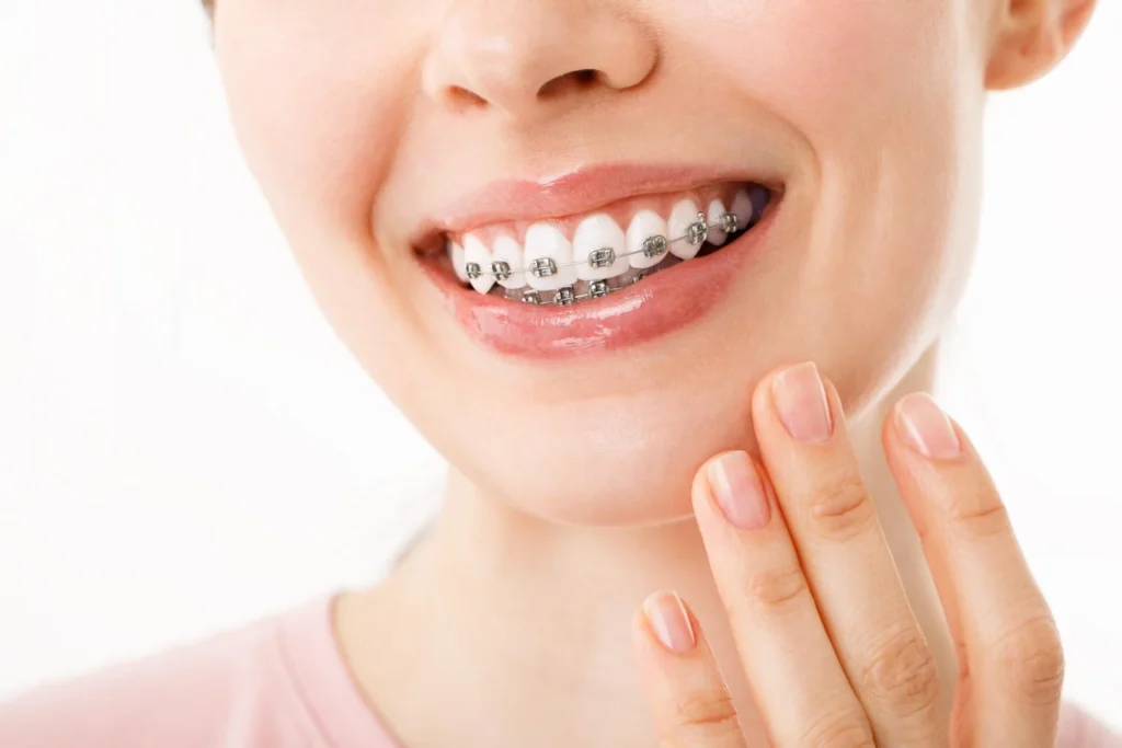 Are Teeth Braces Covered Under Dental Insurance