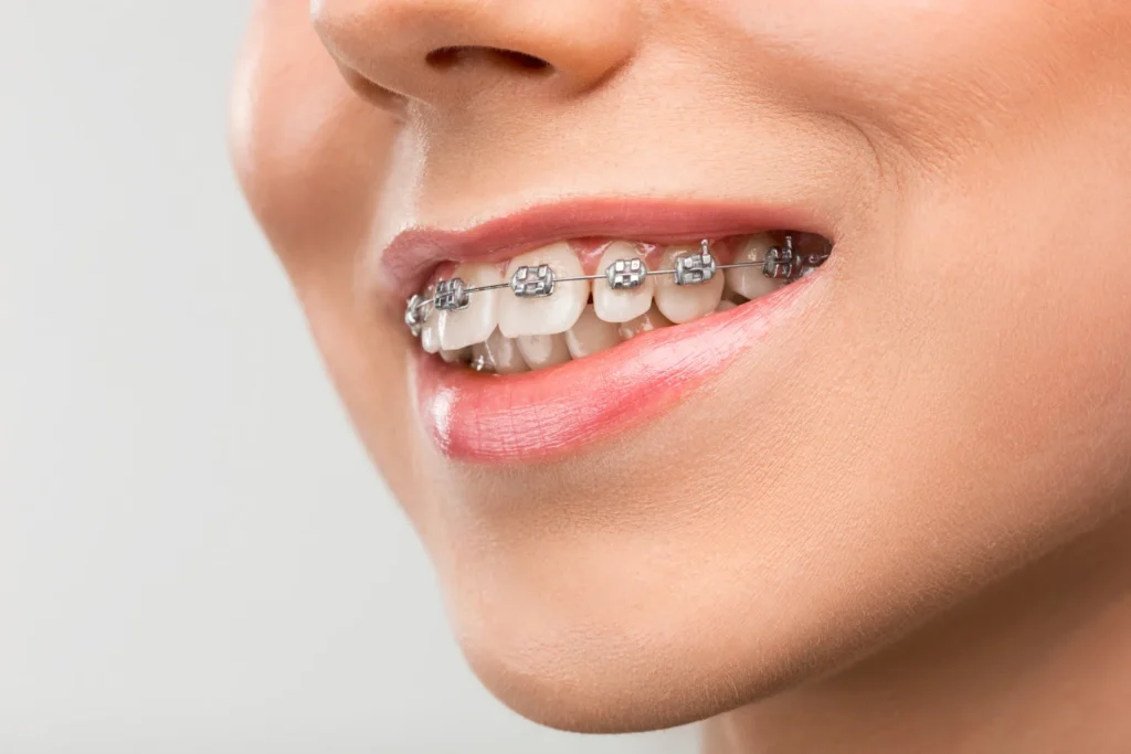 Dental Braces Benefits & Function