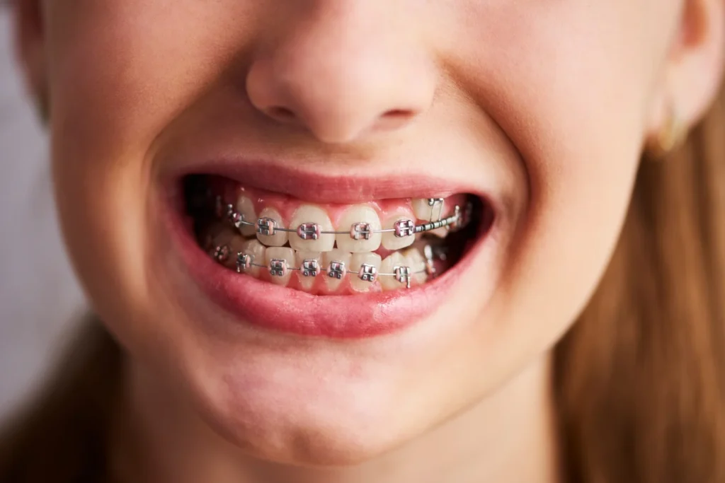 Dental Braces Do's and Don't