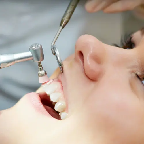 Teeth Cleaning & Polishing