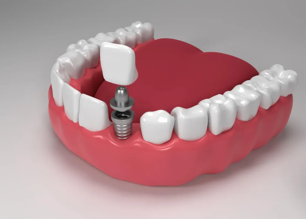 Restore your smile's confidence with advanced dental implants in Viman Nagar