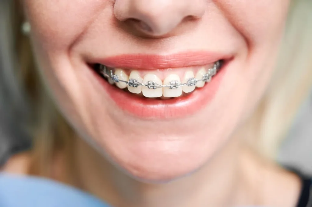 Transform your smile with discreet teeth braces in Viman Nagar!