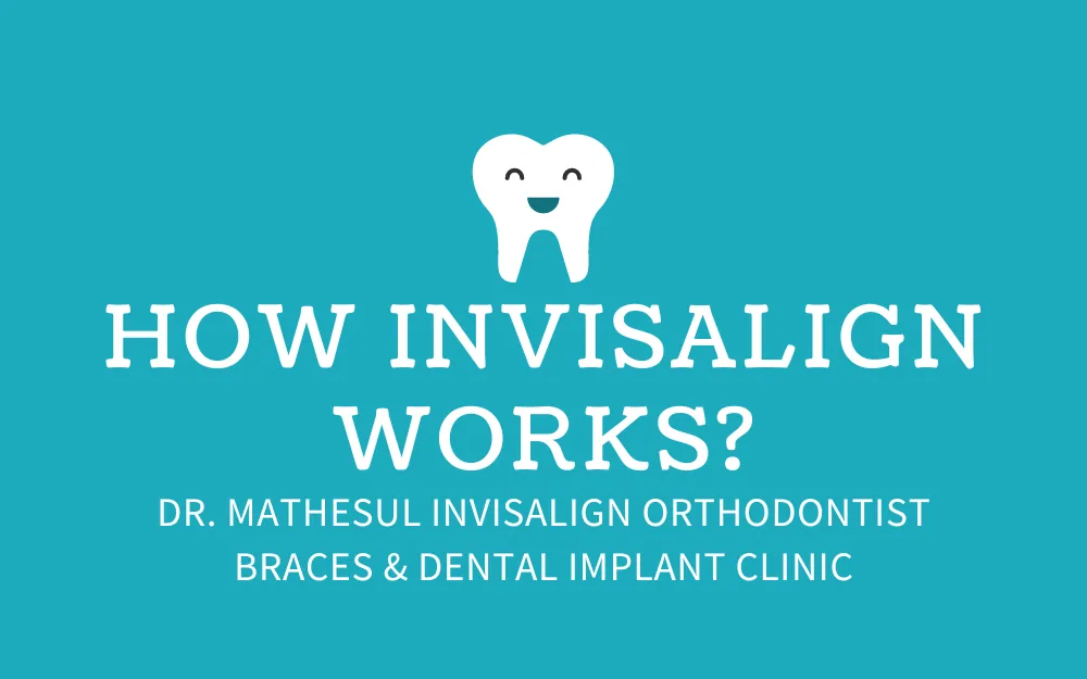 How Invisalign Works to Straighten Teeth