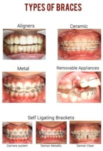 Top Orthodontist Near Me in Pune – Braces & Invisalign Specialists