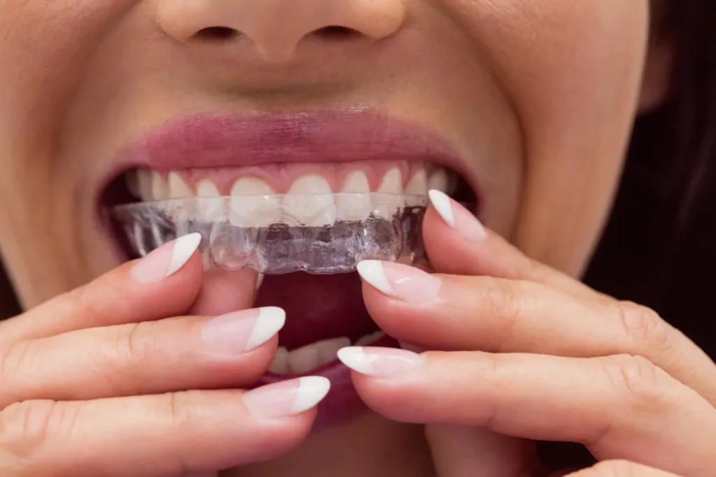 Best invisalign in Kharadi pune