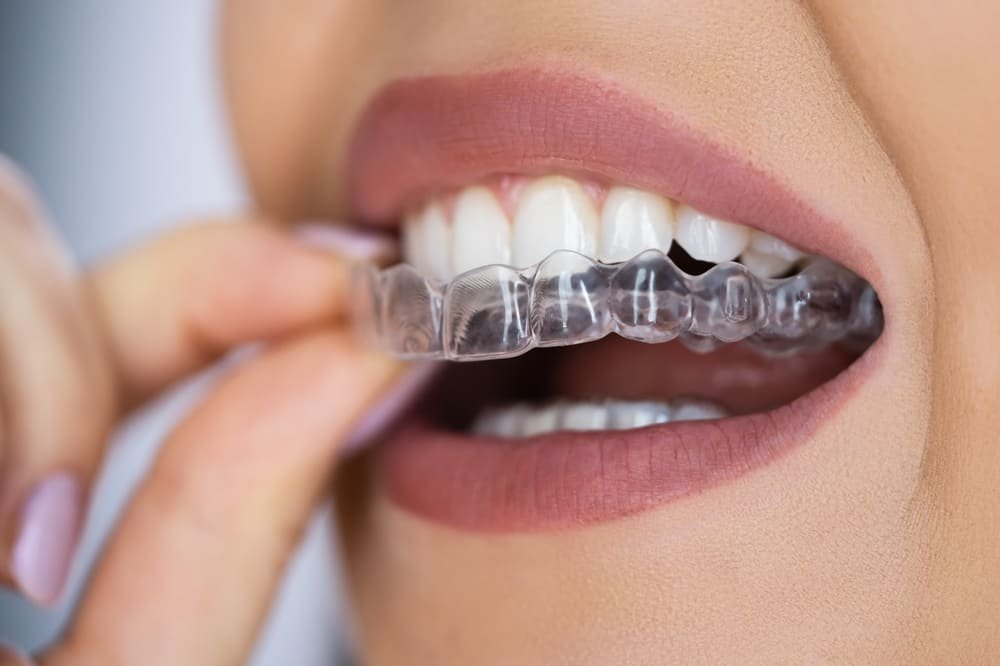 Invisalign in Kharadi pune