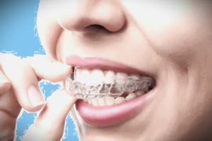 invisalign in pune - invisalign 