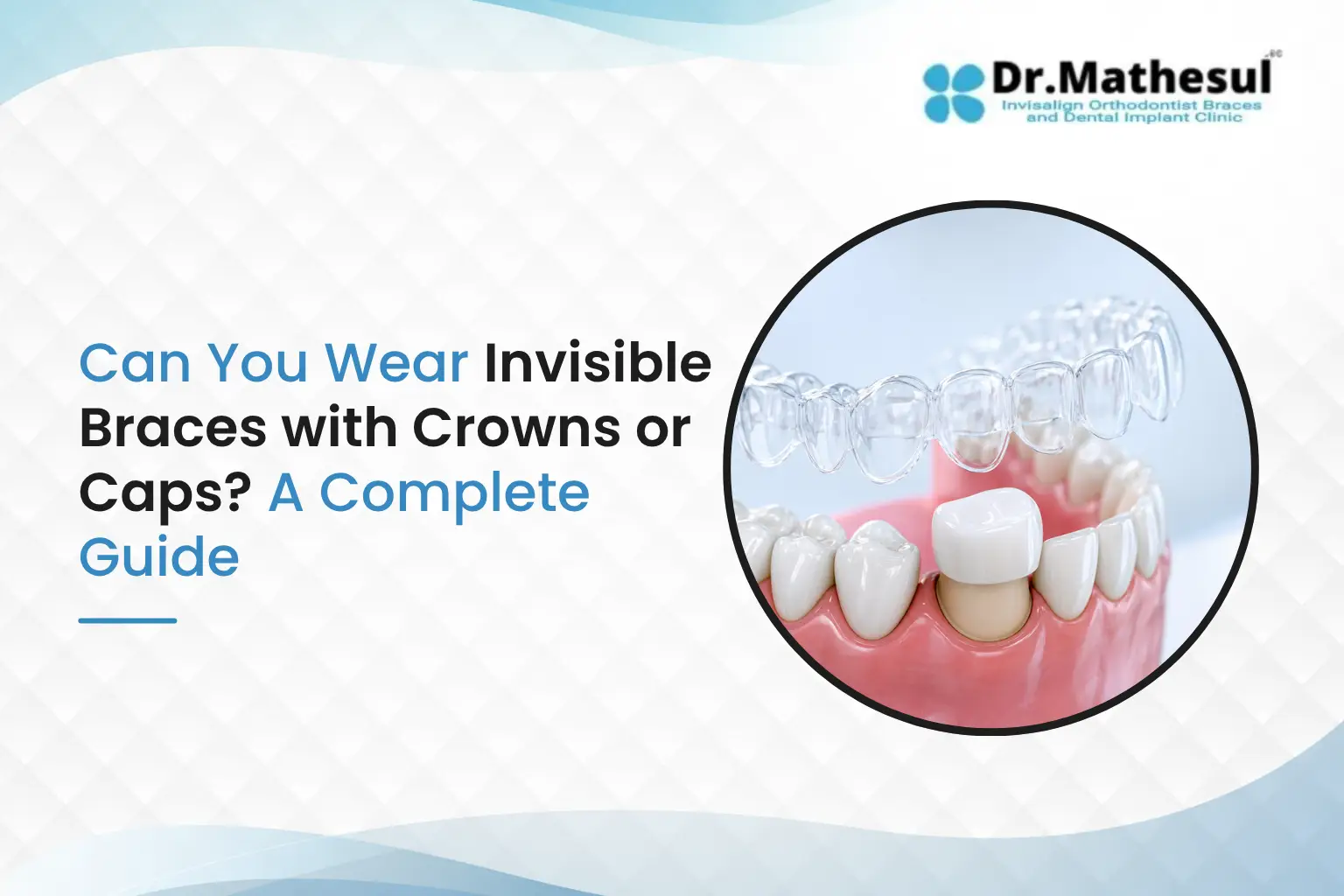 Invisible Braces with Crowns or Caps